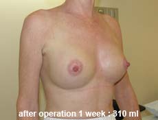 plastic-surgery-breast-augmentation 